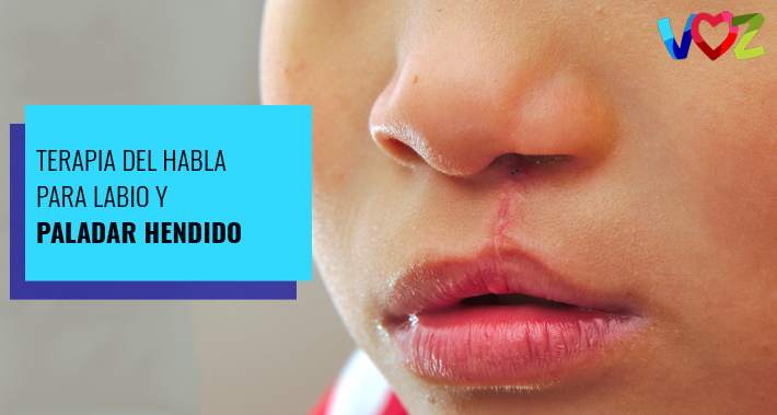 Cleft Lip and Palate Speech Therapy | Clínica Voz Speech Therapy Washington DC | Clínica Voz Speech Therapy Washington DC